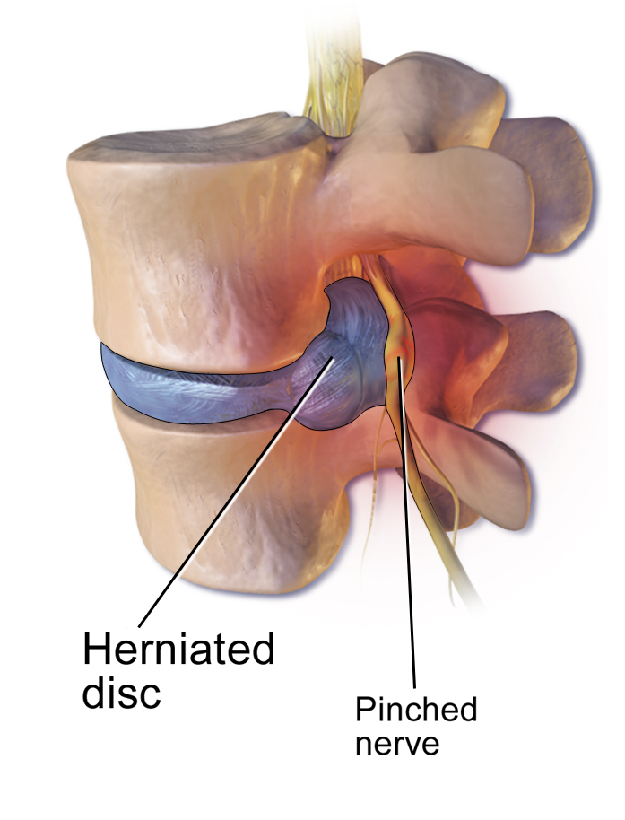 Disc Herniation In The Lumbar Spine